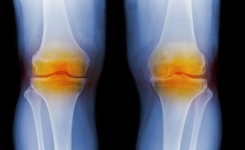 Arthrose : un pansement implantable pourrait régénérer les articulations