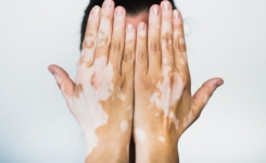 Vitiligo (dépigmentation de l'épiderme) : Causes, Symptômes et Traitement !!