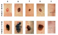 Comment reconnaître les signes d’un cancer de la peau ?
