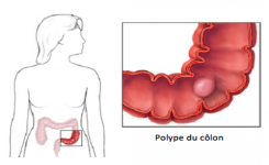 Attention ! Ces symptômes révèlent la présence de polypes au colon ! Tout le monde doit être informé …