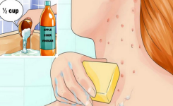 Conseils naturels pour traiter l'acné et l'eczéma avec du vinaigre de cidre