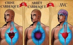 Apprenez les principales différences entre l’arrêt cardiaque, la crise cardiaque et l’AVC