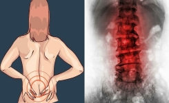 Avez-vous la « maladie silencieuse » ? 3 signes d’alerte précoces de l’ostéoporose !