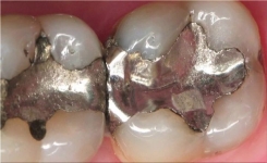 Comprendre les Risques : Ce que Vous Devez Savoir sur le Mercure dans les Plombages Dentaires