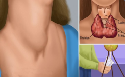 Les médecins ne vous diront jamais ceci : voici comment guérir votre glande thyroïde grâce à ceci