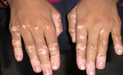Dites adieu au vitiligo, voici un remède naturel peut vous permettre de protéger votre peau
