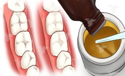 Soigner naturellement vos caries et la détérioration des dents à l’aide de ce puissant remède